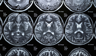Магнитно-резонансная томография (МРТ) головного мозга