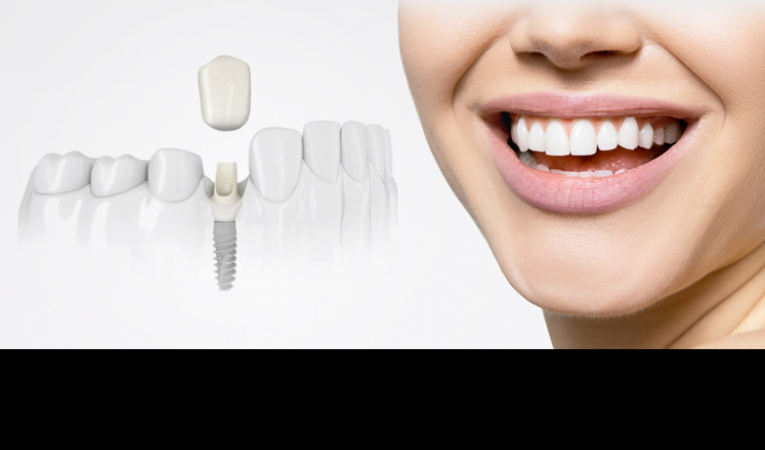 Клиника «ИмплантЗуба» — современный подход к имплантации зубов