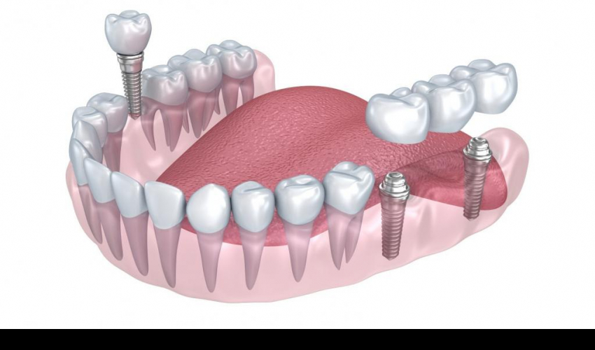 Виды зубных имплантов и показания к установке